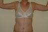 Brachioplasty