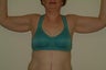 Brachioplasty