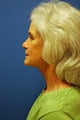 direct neck lift