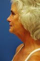 direct neck lift