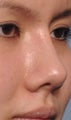 22 Year Old Treated For Flat Nose