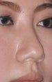22 Year Old Treated For Flat Nose