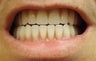 Female Fitted with Full Dentures