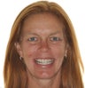 45 year old female open bite, treatment with orthognathic surgery and braces