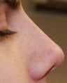 Non-Surgical Rhinoplasty