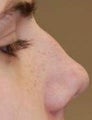 Non-Surgical Rhinoplasty