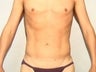 Male Liposuction