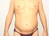 Male Liposuction
