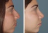 Primary Female Rhinoplasty