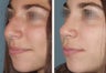 Primary Female Rhinoplasty