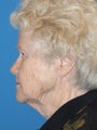 Lower Facelift and Necklift with Platysmaplasty