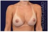 Breast Augmentation