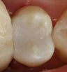 Replacement of Silver Amalgam Filling
