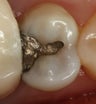 Replacement of Silver Amalgam Filling