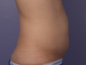 CoolSculpting to Abdomen