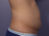 CoolSculpting to Abdomen