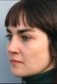 Rhinoplasty