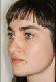 Rhinoplasty
