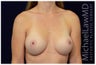 Breast Augmentation