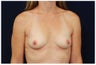 Breast Augmentation