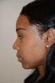 Rhinoplasty