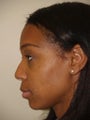 Rhinoplasty