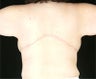Body Contouring - Backlift