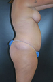 Brazilian Butt Lift