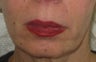 Jowl line