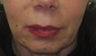 Jowl line
