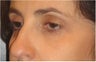 Restylane