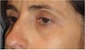Restylane