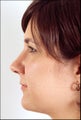 Rhinoplasty for a projecting nose with a hump