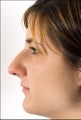 Rhinoplasty for a projecting nose with a hump