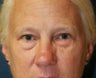 Upper and Lower Eyelid Rejuvenation