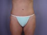 Bodylift