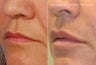 Juvederm - Lips, Nasolabial Folds