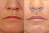 Juvederm - Lips, Nasolabial Folds