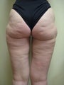 53 year old female treated for cellulite