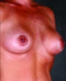Breast Lift with Breast Augmentation