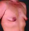 Breast Lift with Breast Augmentation