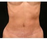 Mommy Makeover Tummy Tuck