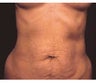 Mommy Makeover Tummy Tuck