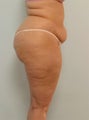 Body Lift