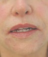 Perlane injections for chin assymmetry