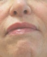 Perlane injections for chin assymmetry