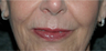 Non-surgical Lip Augmentation