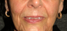 Non-surgical Lip Augmentation