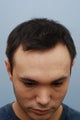 26 year old male treated for hair loss