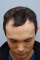 26 year old male treated for hair loss